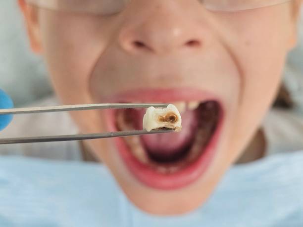 Best Emergency Broken Tooth Repair in Henderson, TN