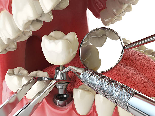 Best Emergency Root Canal Treatment in Henderson, TN